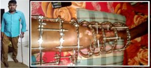 Read more about the article Support for SHUBROTA SAHA to fight with Ankle disorder, a serious disease