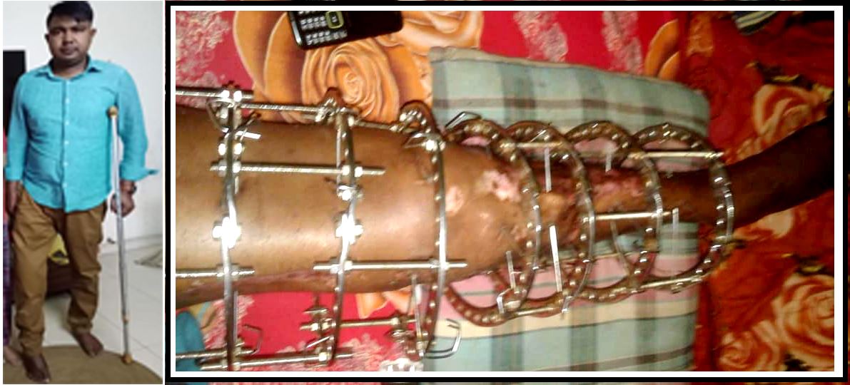 Read more about the article Support for SHUBROTA SAHA to fight with Ankle disorder, a serious disease